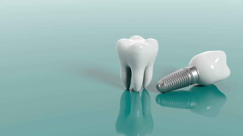 Implante dentário: quais são os benefícios?