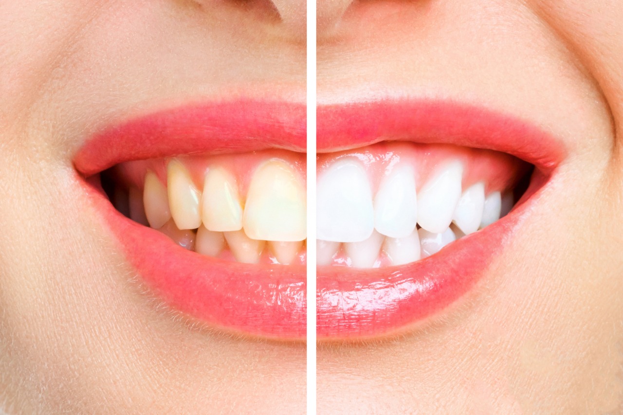 Clareamento dental e suas vantagens